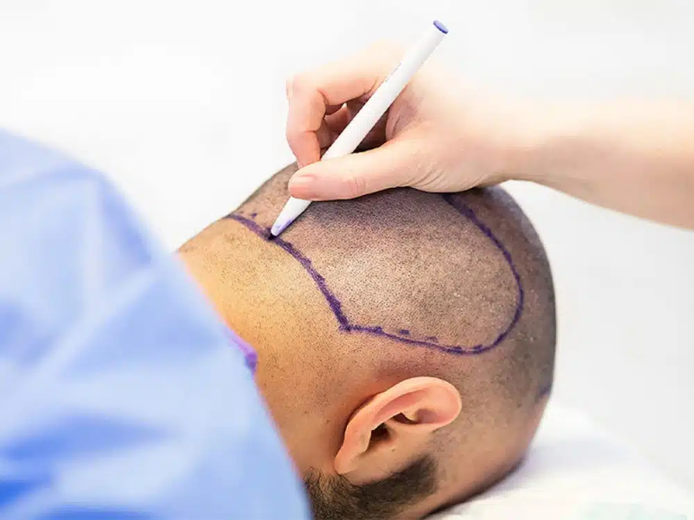 What is Donor Area in Hair Transplantation