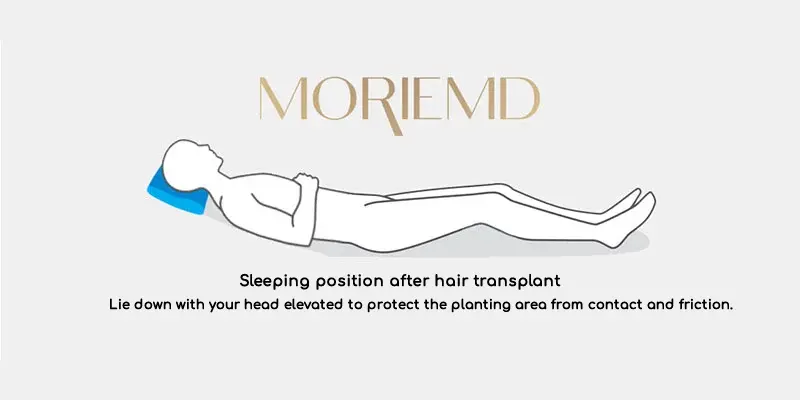 Hair Transplantation Sleeping Position