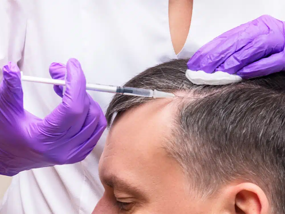 What Does PRP (Platet Rich Plasma) Treatment Mean in Hair Transplantation