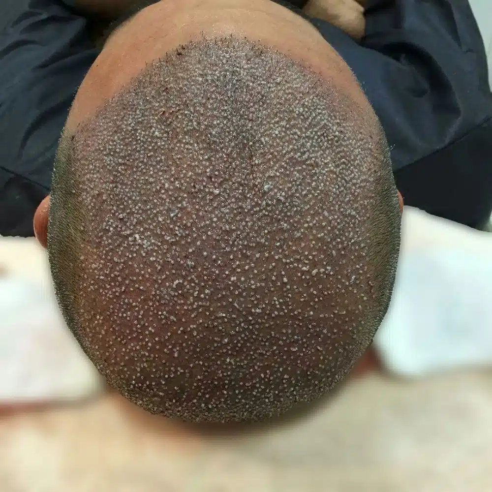 What is Lateral Slit Technique in Hair Transplantation and Is It Included in FUE Method