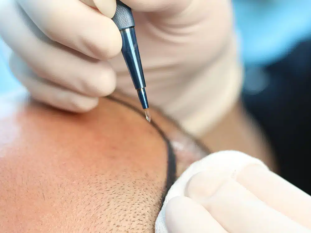 What is Sapphire Technique in Hair Transplantation