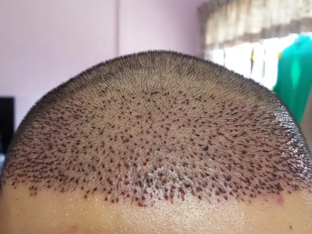 Removing the Crusts After Hair Transplantation