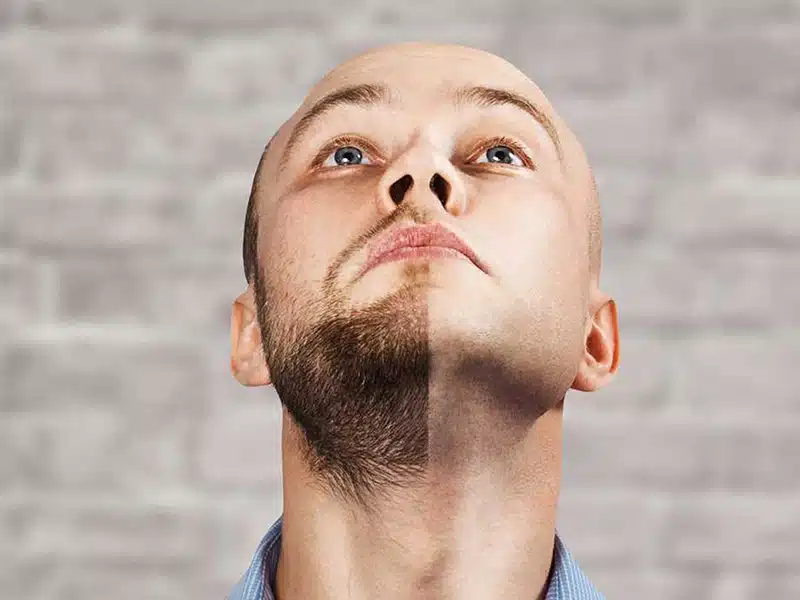 Beard Transplant Operation and Hair