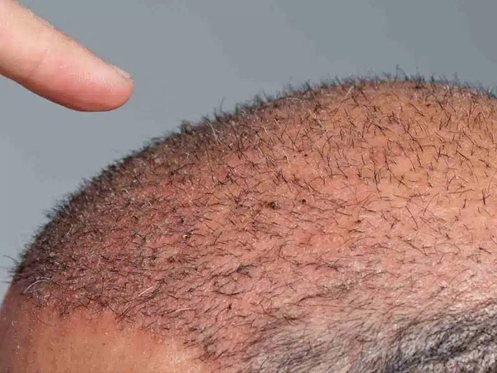 when-does-hair-grow-back-after-shock-hair-loss