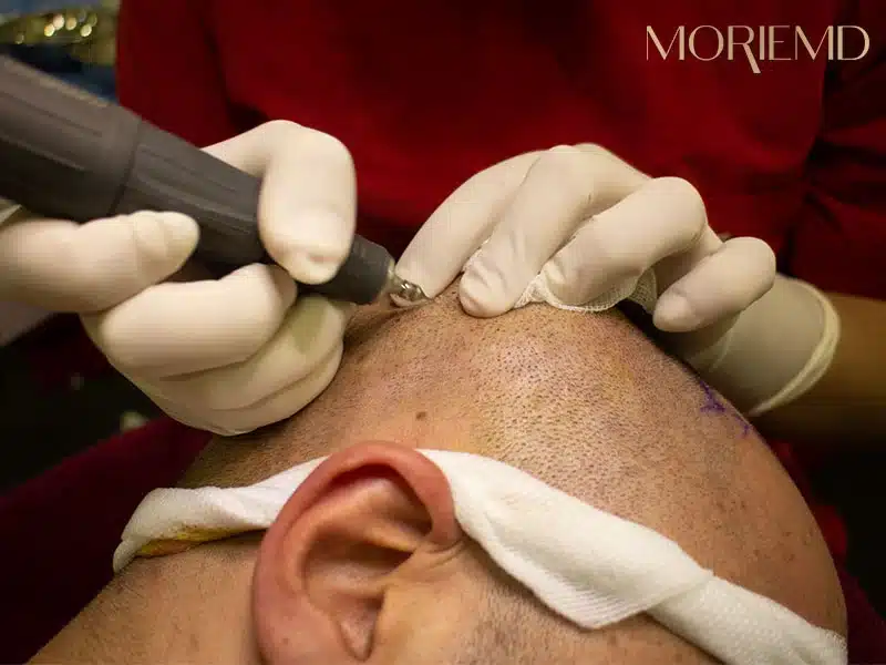 FUE – Lateral Slit Hair Transplant