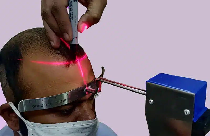 FUE Hair Transplant