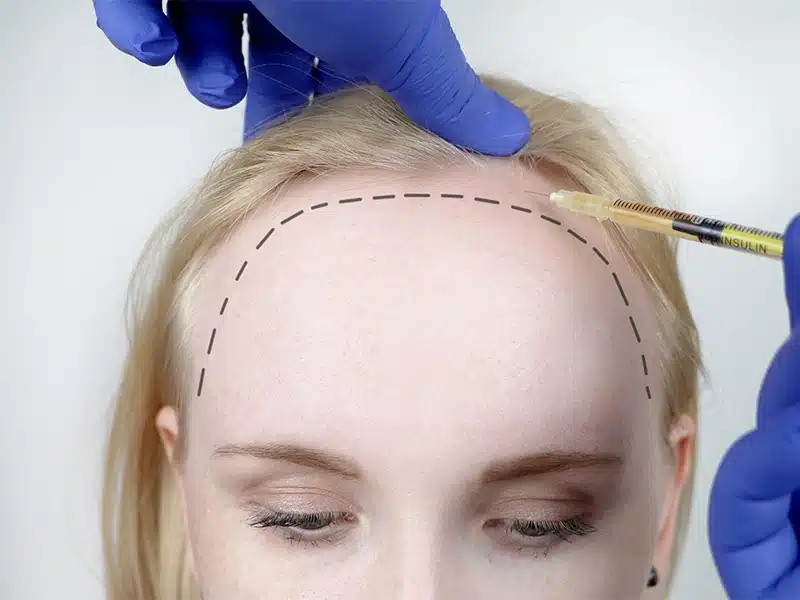 Hair Transplant Operation in Women