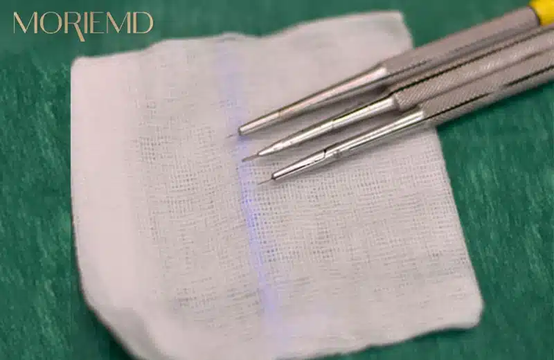 FUE – Lateral Slit Hair Transplant