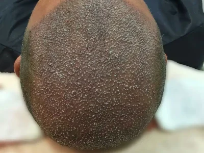 What is Lateral Slit Technique in Hair Transplantation and Is It Included in FUE Method